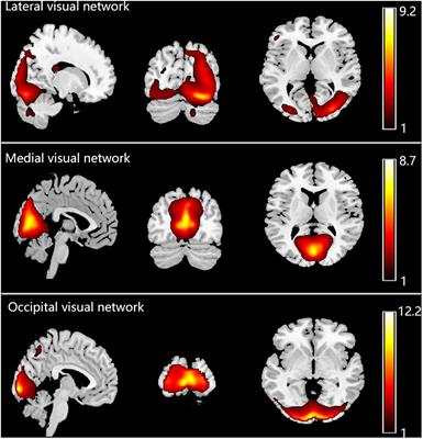 Functional Alterations in Resting-State Visual Networks in High-Tension Glaucoma: An Independent Component Analysis